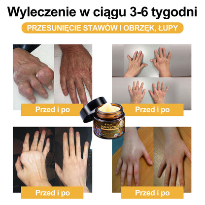 🎉XRLXRL® Krem z jadem pszczelim o natychmiastowym, wyjątkowo silnym działaniu przeciwbólowym – (Łagodzi ból związany z zapaleniem stawów, bólem mięśni i pleców oraz dolegliwościami kolan, barków, bioder, nadgarstków i dłoni)